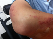 What Should When Facing Injury That Hurts Your Lifestyle