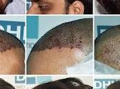 Unique Diagnostic System Alopecia (UDSA) India