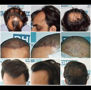 Unique Diagnostic System of Alopecia (UDSA) – DHI India