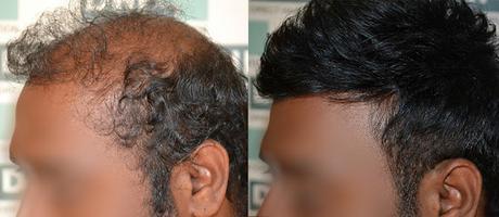 Get the Best Hair Restoration and Beard Transplant in Kolkata