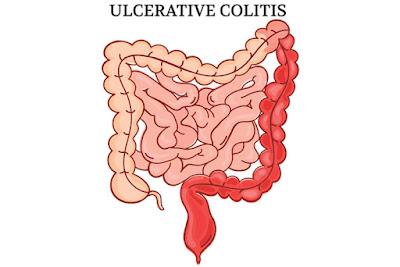 Ulcerative Colitis Market The mucosal lining of the colon is affected by ulcerative colitis, a chronic idiopathic inflammatory bowel disease (IBD) affecting the gastrointestinal system.