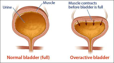 Treatment of Overactive Bladder in Ayurveda With Herbal Remedies