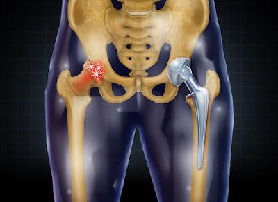 Hip Replacement Market Hip replacement is a surgical operation in which a prosthetic implant is used to replace a hip joint.