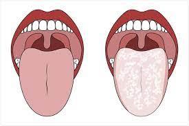 The global candidiasis market is primarily driven by an increase in candidiasis instances worldwide, as well as a high rate of candidiasis diagnosis and treatment. candidiasis market