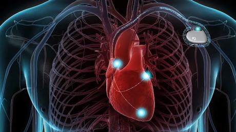 The impact of COVID-19 on the global Implantable Cardioverter-defibrillators Market Implantable Cardioverter-defibrillators Market