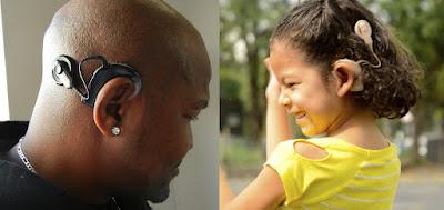 A cochlear implant is a surgically implanted electronic device that produces usable hearing perceptions. Individuals with severe to profound nerve deafness have it placed in their inner ear.