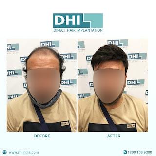 Say Goodbye To Stressful Hair Problems With A Successful Hair Transplant!