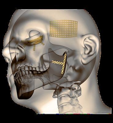 Craniomaxillofacial implants can be used to address a variety of congenital diseases, facial deformities, and for cosmetic reasons.