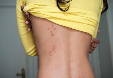 Bed Bug Extermination Bed Bug Extermination