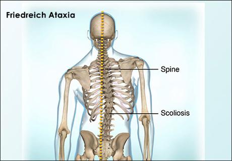 Natural Cure For Friedreich Ataxia With Herbal Remedies