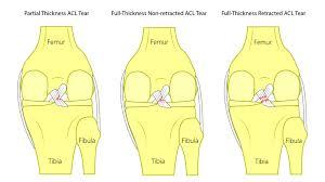 ACL Tear Treatment Without Surgery: Our New Publication!
