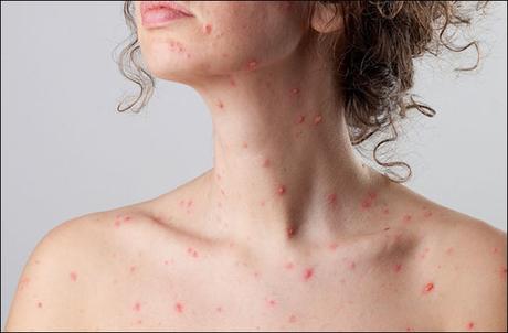 Natural Cure For Shingles or Herpes Zoster