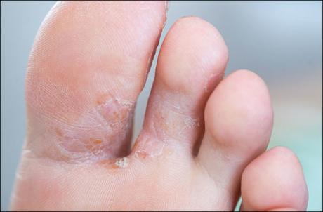 Natural Cure For Athlete’s Foot (Tinea Pedis)