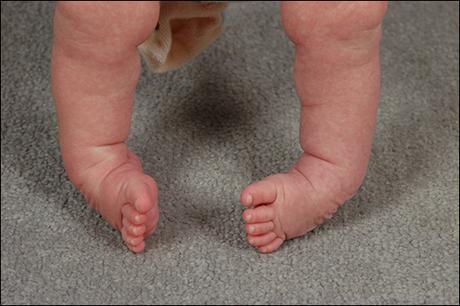 What is Clubfoot? – Causes, Symptoms & Ayurvedic Treatment
