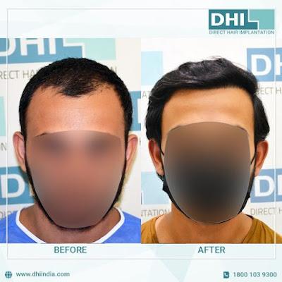 best hair transplant clinic in Chennai