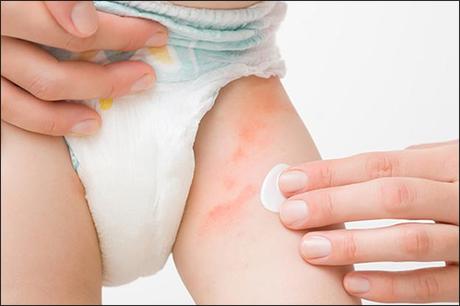 Ayurvedic View On Diaper Rash With Herbal Remedies