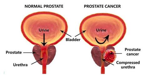 prostate cancer sympotoms, treatments, causes