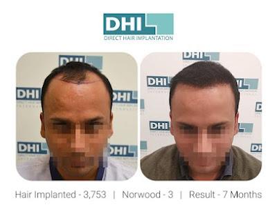 hair transplant in Kolkata