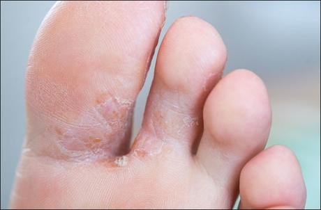 Natural Cure For Fungal Infections