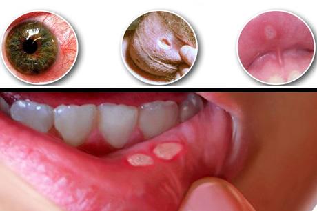 What is Behcet Syndrome?- Causes, Symptoms and Ayurvedic Treatment