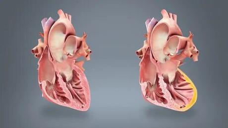 Myocardial Infarction Market - Global Industry Analysis, Size, Share, Growth, Trends and Forecast 2015 - 2023 Myocardial Infarction Market
