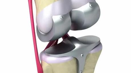 Knee Implants Market - Global Industry Size, Share, Trends, Analysis and Forecast 2021-2031 Knee Implants Market