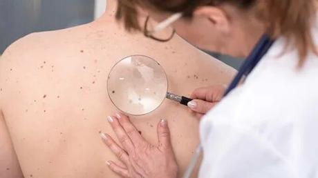 Melanoma Treatment Market – Global Industry Insights, Trends, Outlook, and Opportunity Analysis, 2018 – 2026 Melanoma Treatment Market