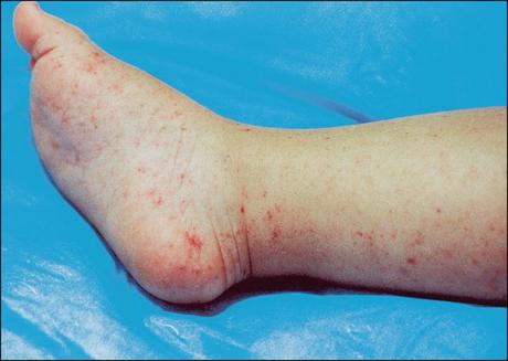 Natural Cure For Rocky Mountain Spotted Fever