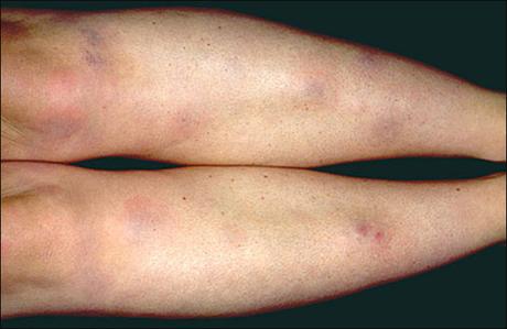 Ayurvedic Treatment For Erythema Nodosum