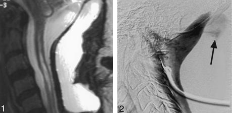 finding csf leak with digital subtraction myelogram