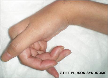 Treatment Of Stiff Person Syndrome With Herbal Remedies
