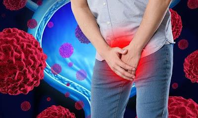 Bladder Cancer Therapeutics Market Bladder cancer is characterised by abnormal growth of tissues in the bladder's inner layer.