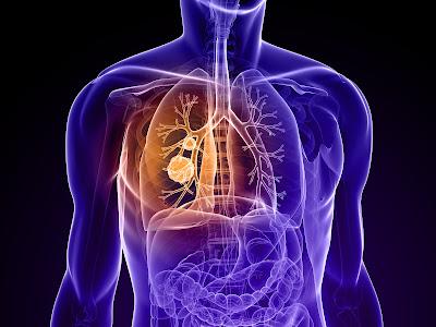 Lung Cancer Therapeutics Market Lung cancer, also known as lung carcinoma, is a disease that causes uncontrolled cell growth in the lungs.