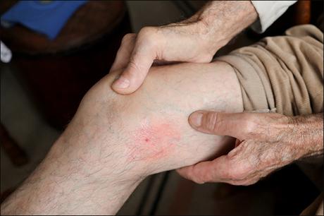 Alternative Treatment For Hypercoagulability With Herbal Remedies