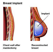 breast reconstruction