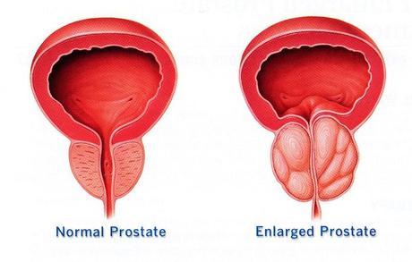 Benign Prostatic Hyperplasia (BPH) Enlarged Prostate