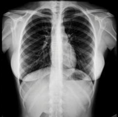 X-Ray of woman's chest