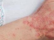 Treatment Fungal Infections Ayurveda