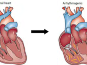 Natural Cure Arrhythmogenic Right Ventricular Cardiomyopathy (ARVC)