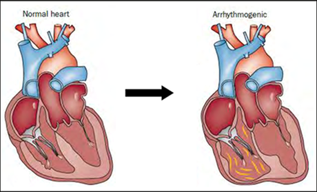 Natural Cure For Arrhythmogenic Right Ventricular Cardiomyopathy (ARVC)