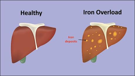 What Causes Iron Overload Disorder & Its Ayurvedic View