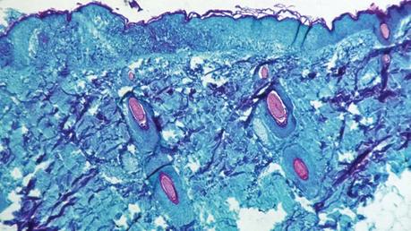 A section of skin tissue, harvested from a lesion on the skin of a monkey, that had been infected with monkeypox virus 