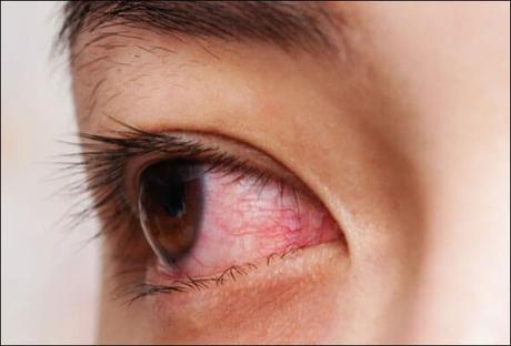 Natural Cure For Scleritis with Herbal Remedies