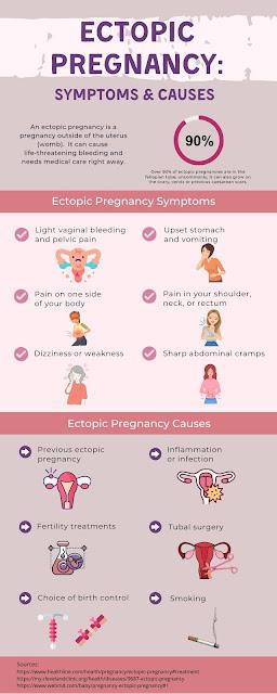 ECTOPIC PREGNANCY:  Symptoms and Causes