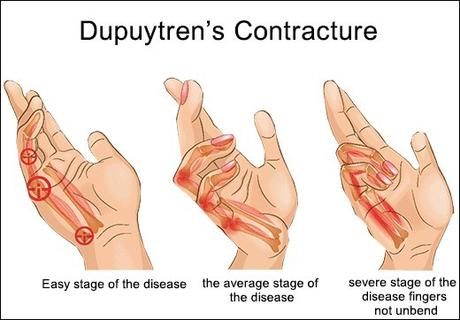 Natural Cure For Dupuytren’s Contracture With Herbal Remedies