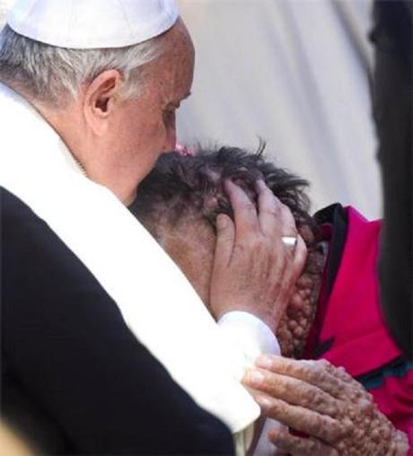 Pope Francis kisses man with tumors