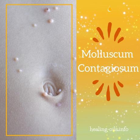 Treatment for Molluscum Contagiosum