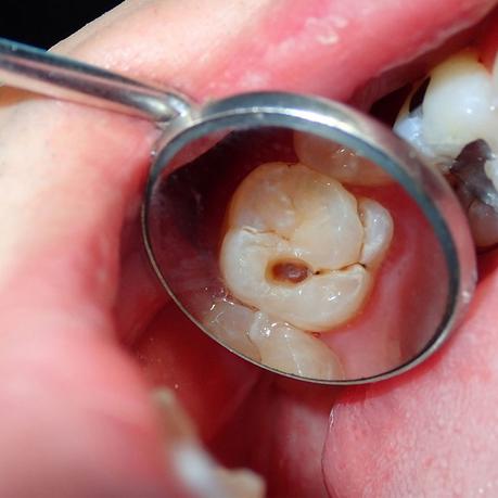 What Causes Cavities?