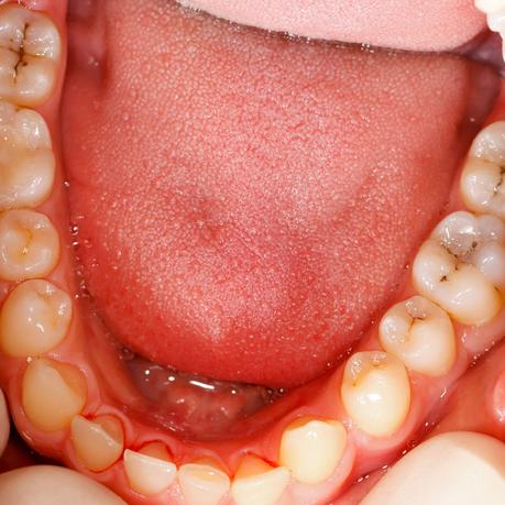 What Is A Cavity? What Causes Cavities?