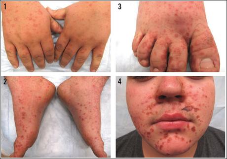 What Is Hand, Foot, And Mouth Disease?- Is It Manageable?